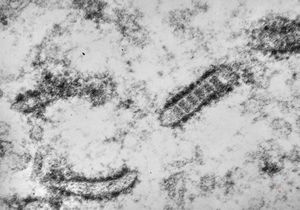 M, | rinclusions in the endoplasmic reticulum … unclassified abdominal tumor M, | rinclusions in the endoplasmic reticulum … unclassified abdominal tumor